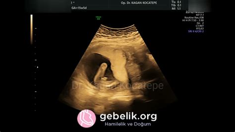 1 aylık ultrason görüntüsü